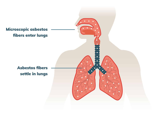 Graphic of how mesothelioma is caused Graphic of how mesothelioma is caused